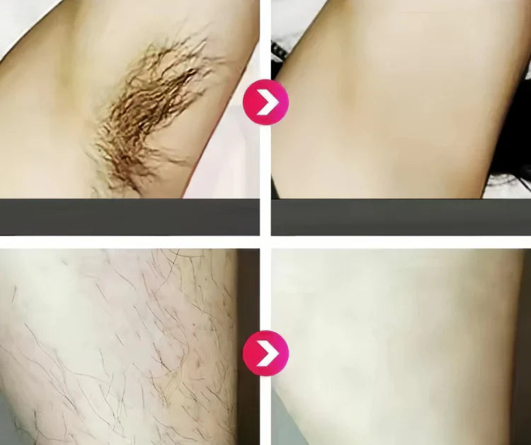 IPL Laser Hair Removal Device